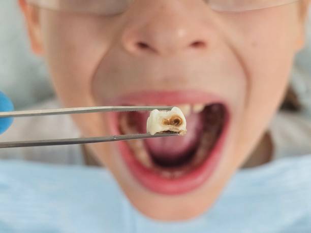 Best Broken Tooth Emergency  in Marina Del Rey, CA
